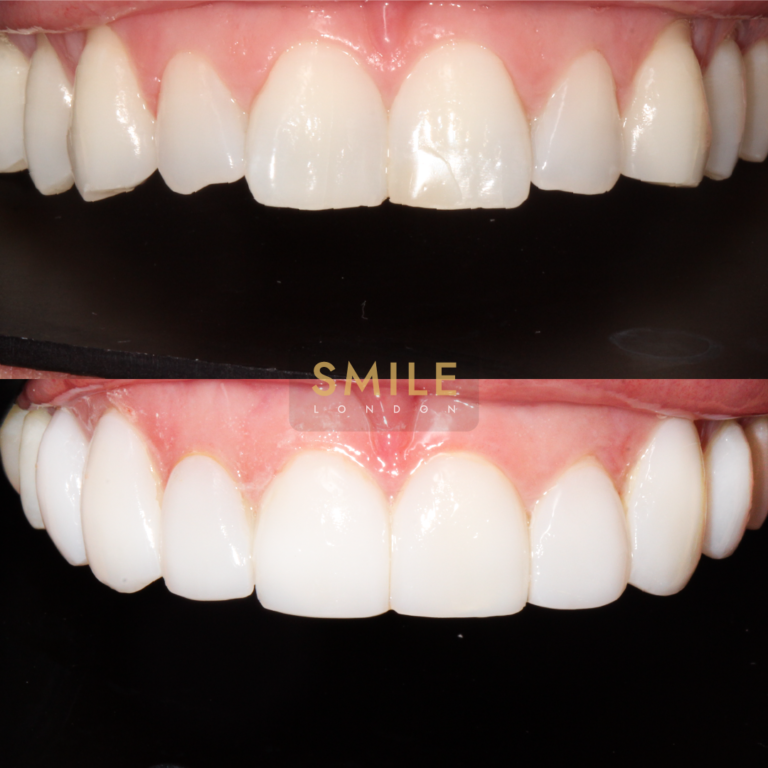 teeth composite bonding