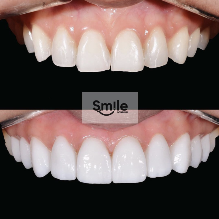 teeth composite bonding