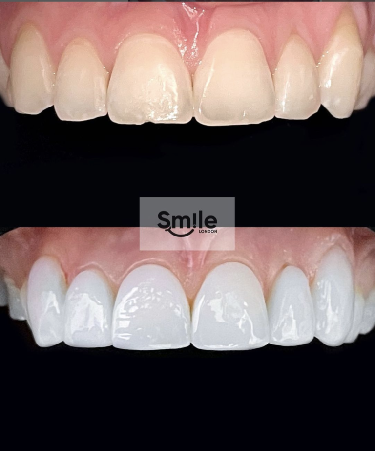 teeth composite bonding