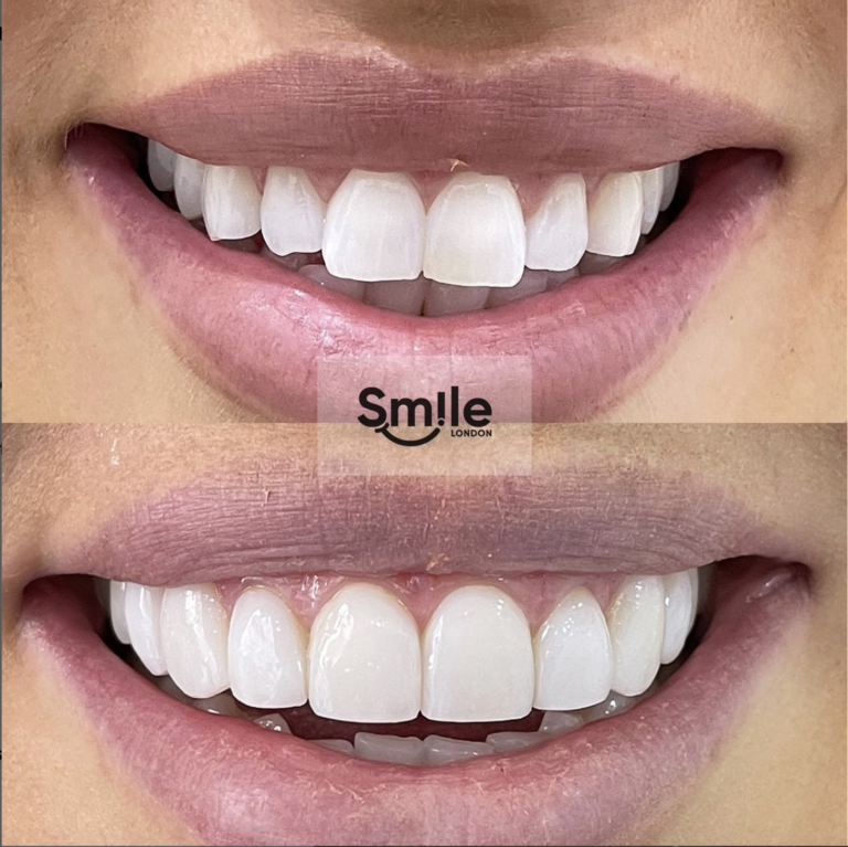 teeth composite bonding