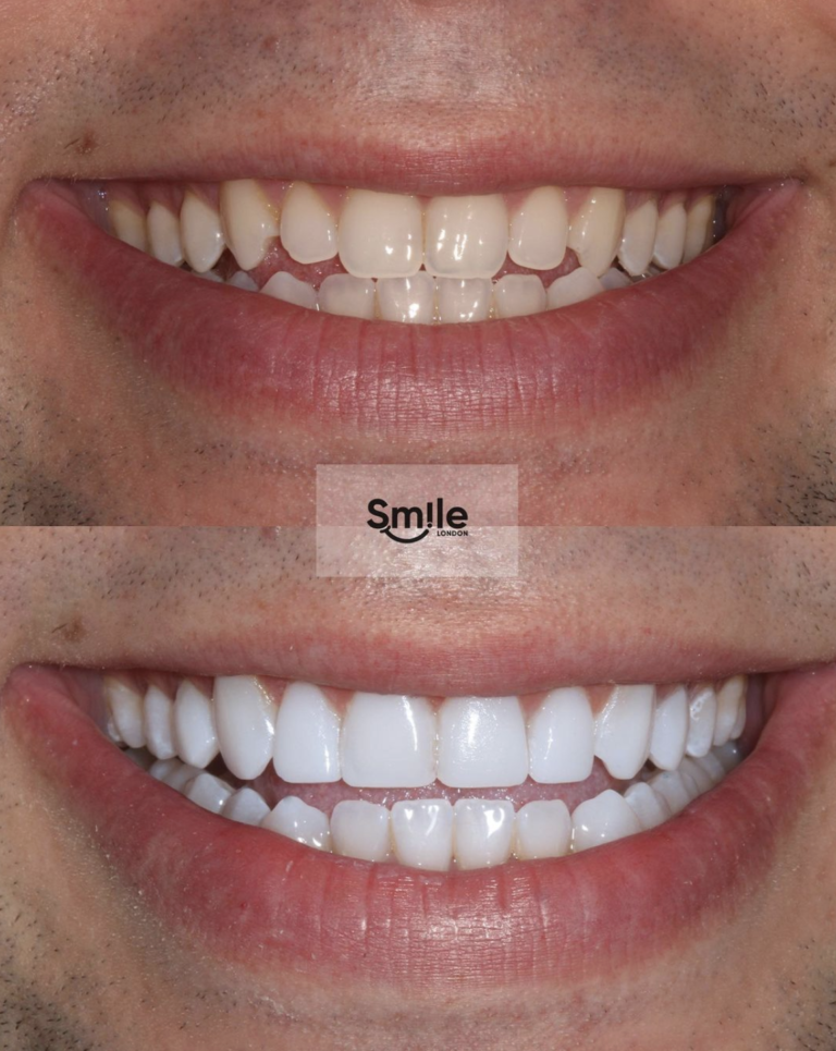 teeth composite bonding