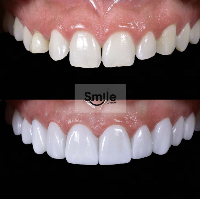 teeth composite bonding