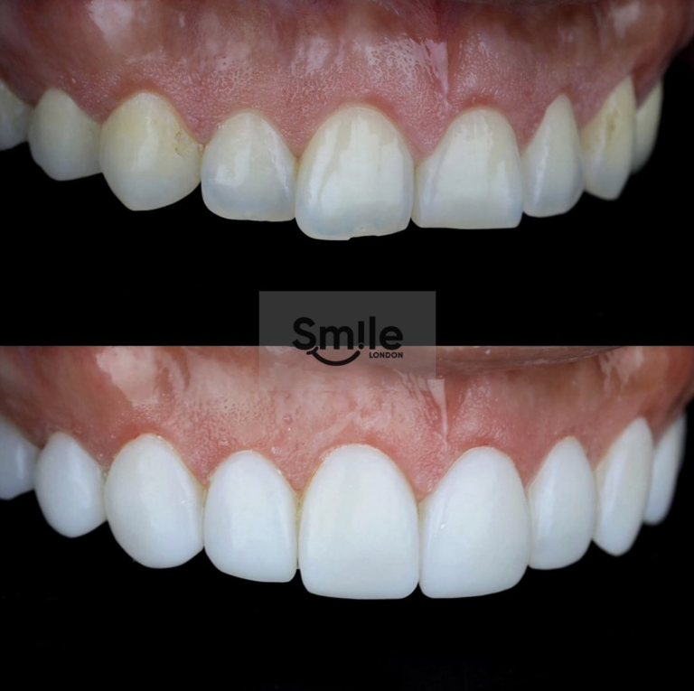 teeth composite bonding