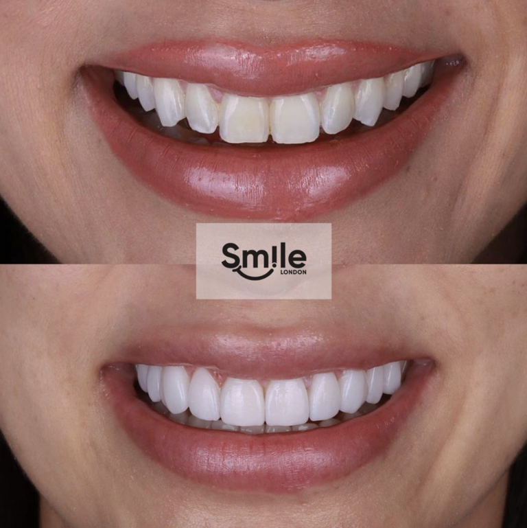 teeth composite bonding