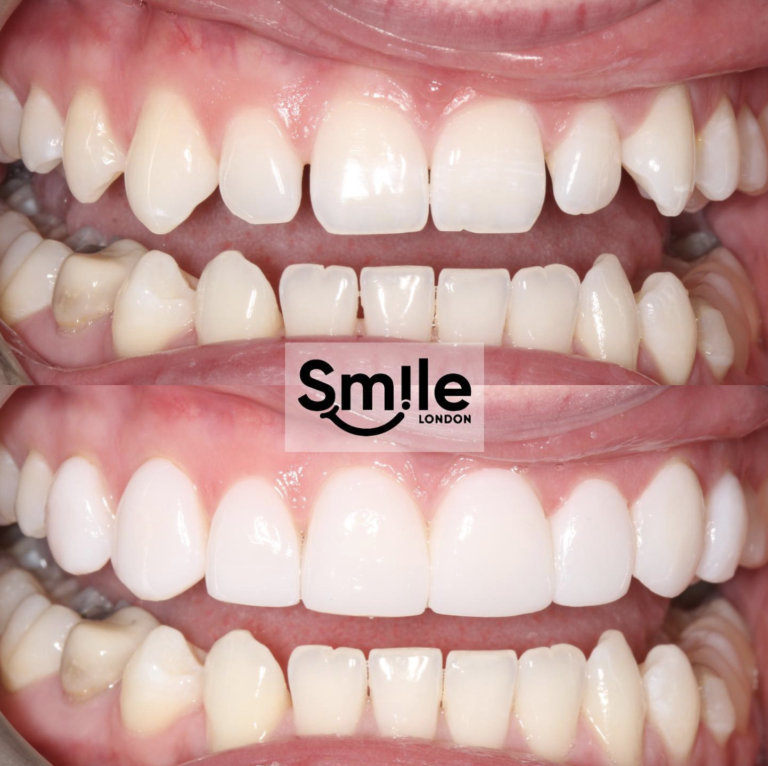 teeth composite bonding