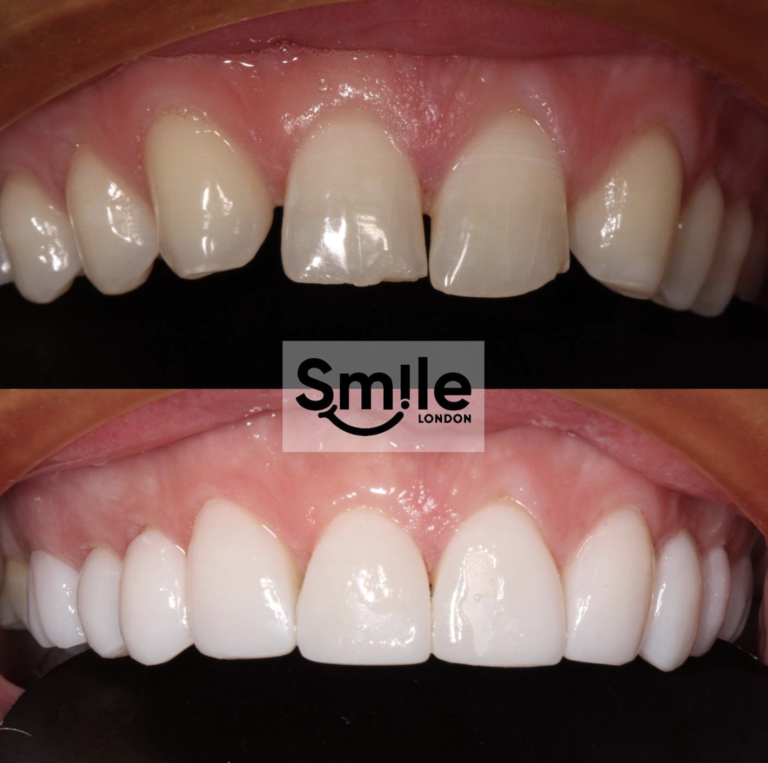 teeth composite bonding