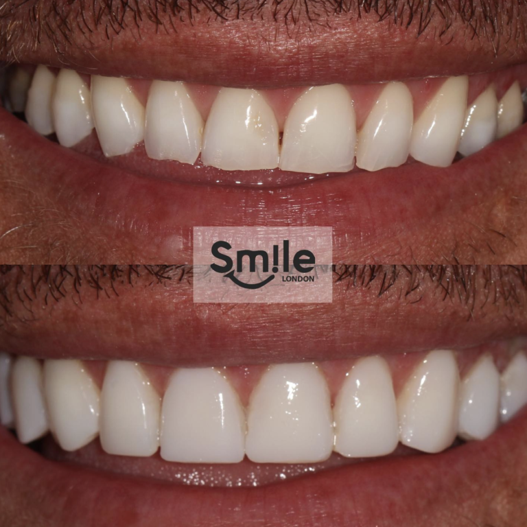 teeth composite bonding