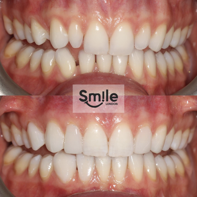 teeth composite bonding