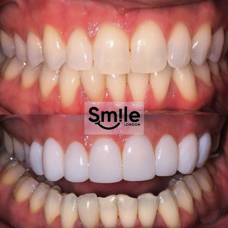 teeth composite bonding