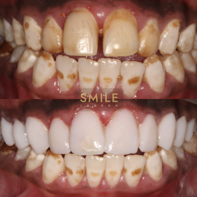 teeth composite bonding