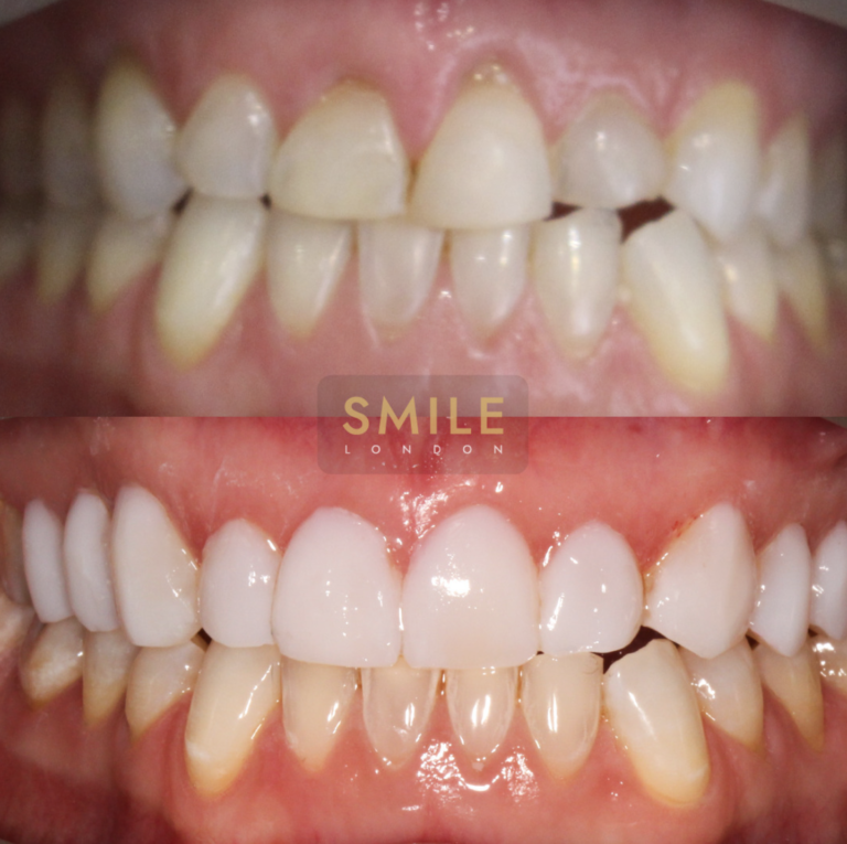 teeth composite bonding