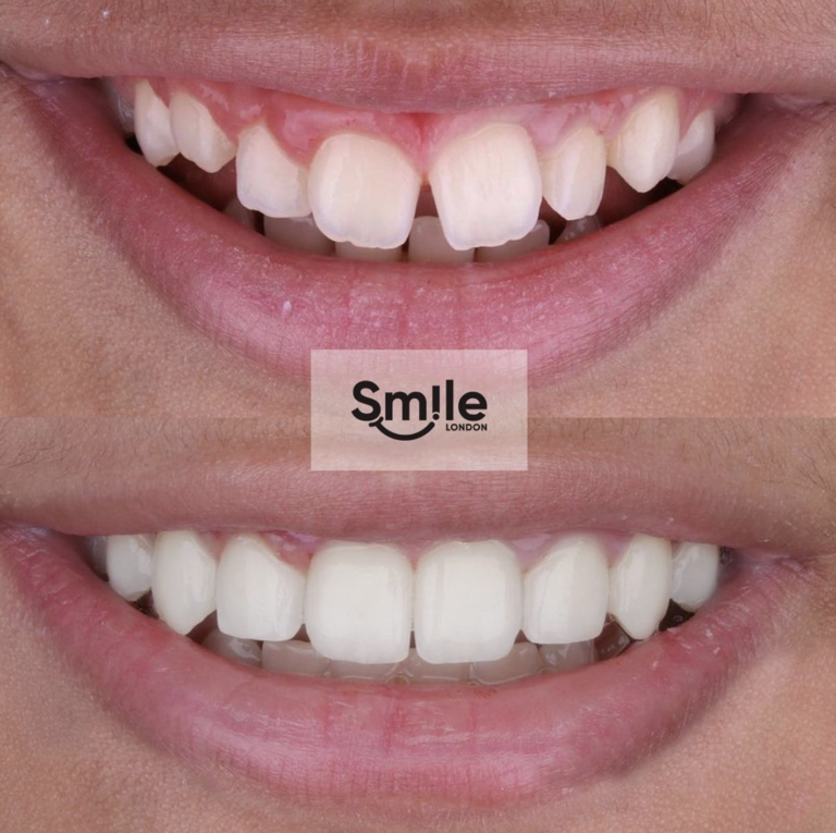 orthodontics before & after