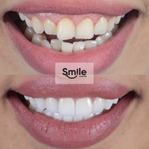 orthodontics before and after