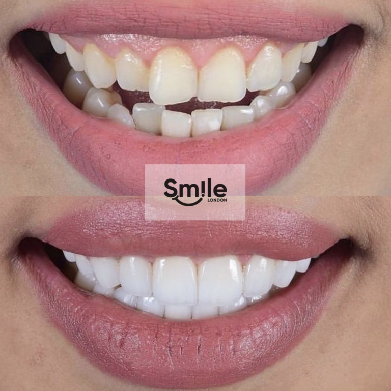 orthodontics before and after