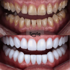 smile gallery emax veneers