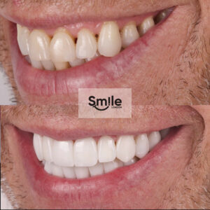 smile gallery dental implants