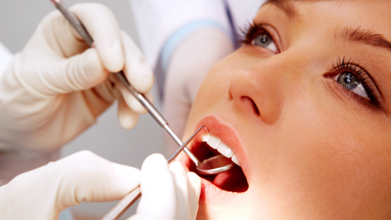 Dental Fillings