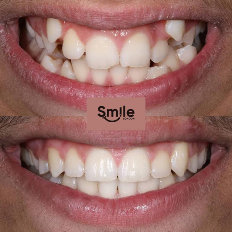 orthodontics before & after