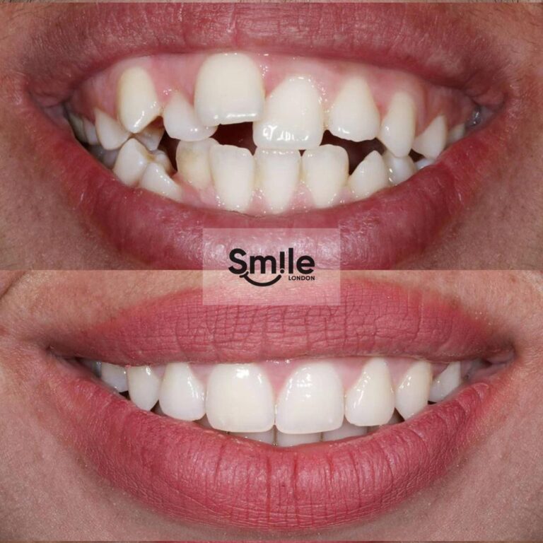 orthodontics before & after