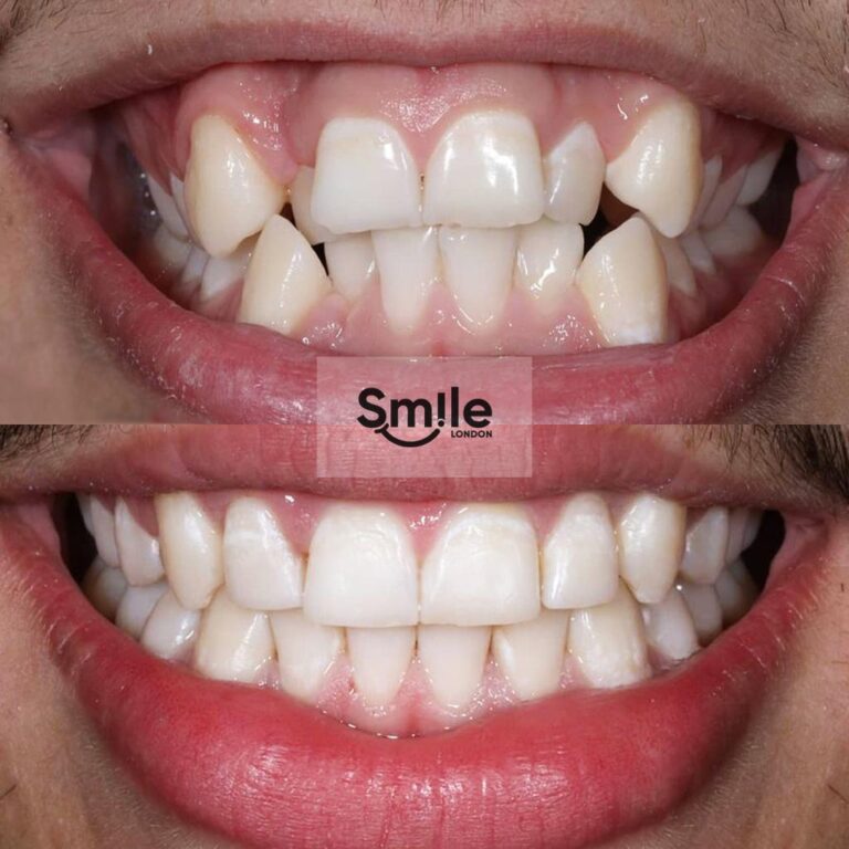 orthodontics before & after