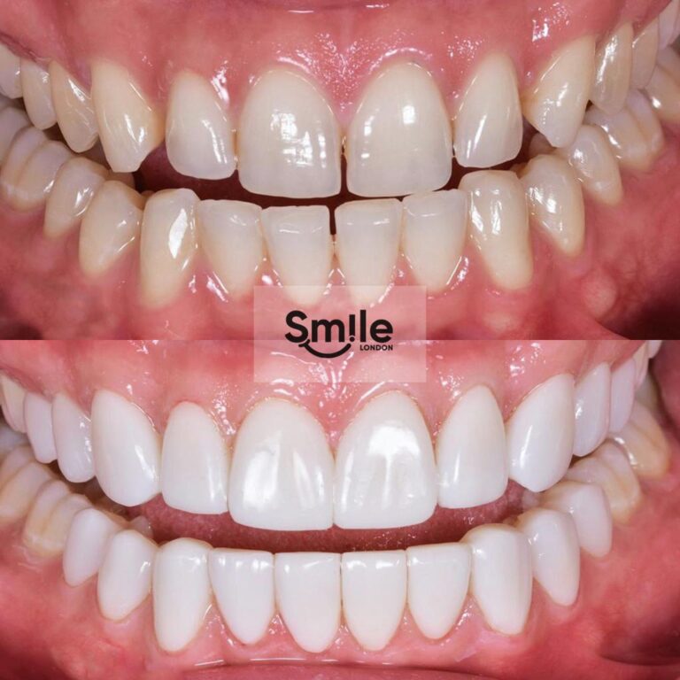 smile gallery emax veneers