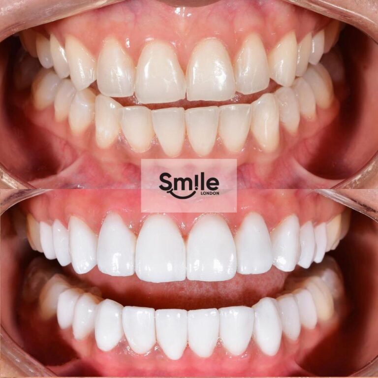 smile gallery emax veneers