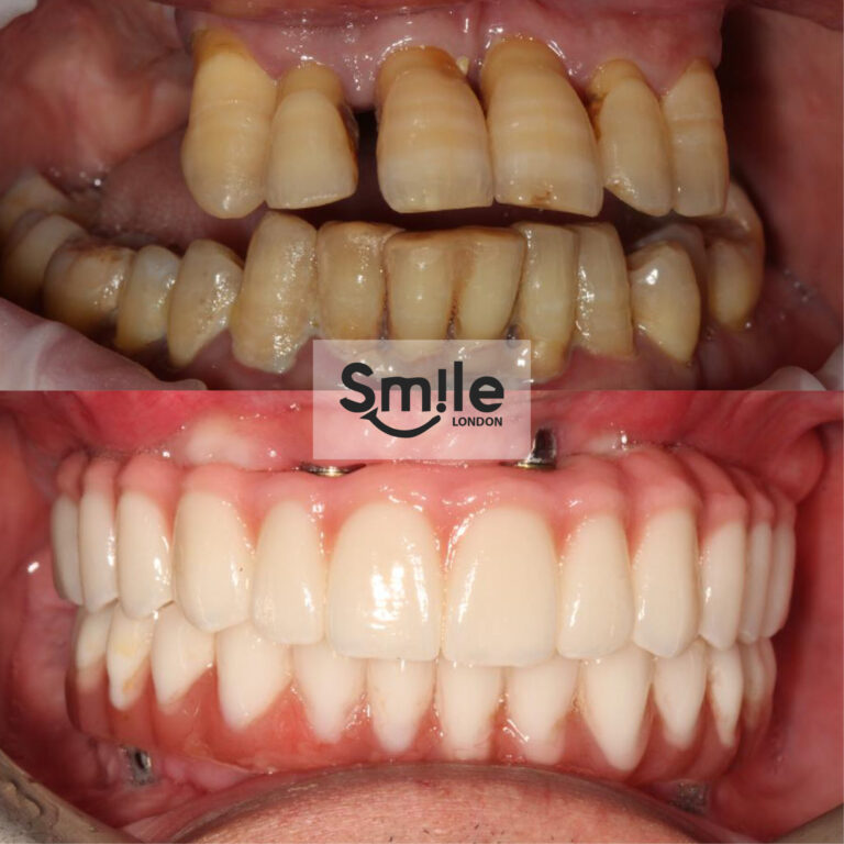 dental implants- before & after