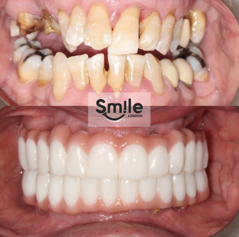 dental implants before and after