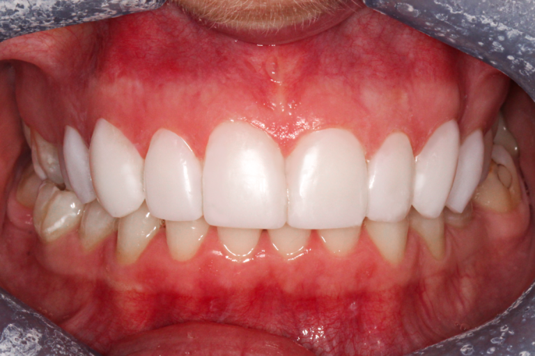 oliva after teeth