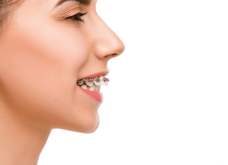 orthodontic solutions to an overbite