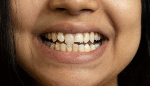 Chipped front tooth close-up | chipped tooth repair guide | Smile London Harley Street
