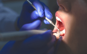 Turkey teeth risks explained — what happens to your teeth during dental tourism treatment abroad | Smile London | Harley Street Dentist